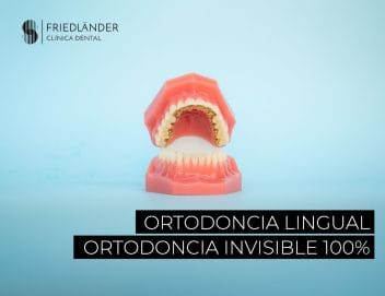 ortodoncia lingual incognito