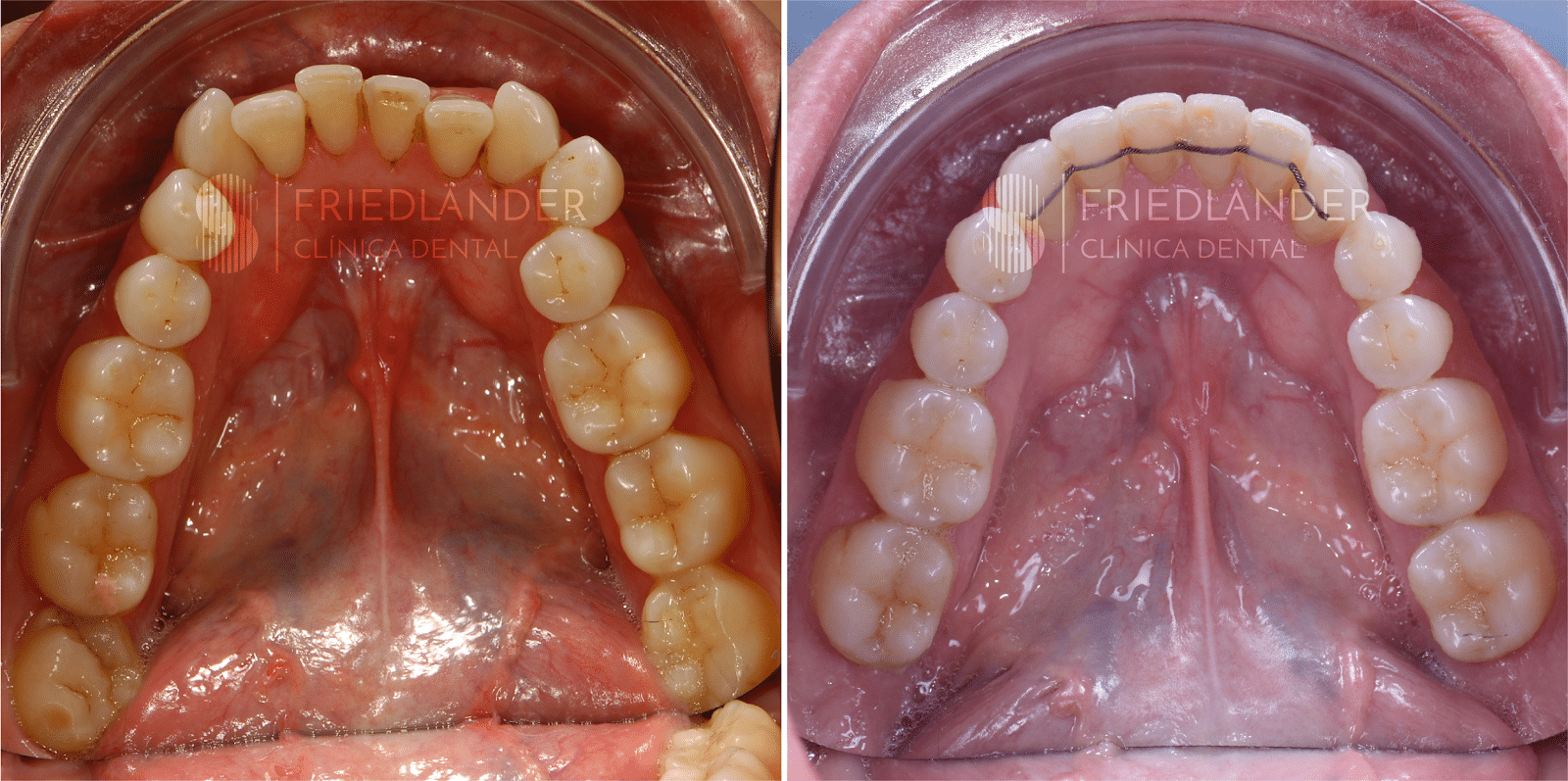 marzo Método Atticus Retenedores fijos dentales | La retención fija en ortodoncia