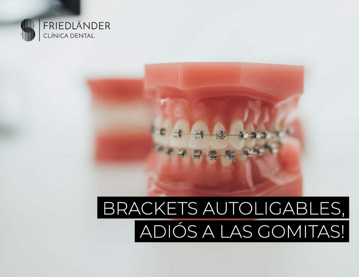 Brackets autoligables ¿Qué son? Clínica Friedländer