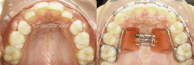 Ortodoncia Friedlander Barcelona tratamiento de extracción dental