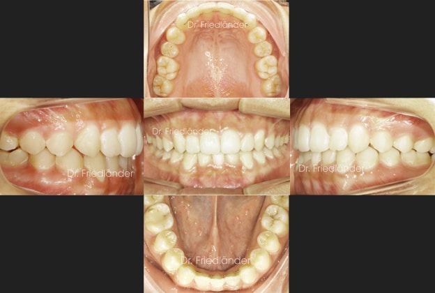 Ortodoncia Friedlander Barcelona Ortodoncia Friedlander Barcelona invisalign invisible incognito lingual adultos