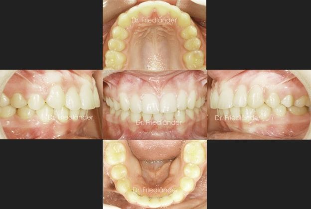 Ortodoncia Friedlander Barcelona iv final ortodoncia friedlander barcelona invisalign invisible lingual incognito damon