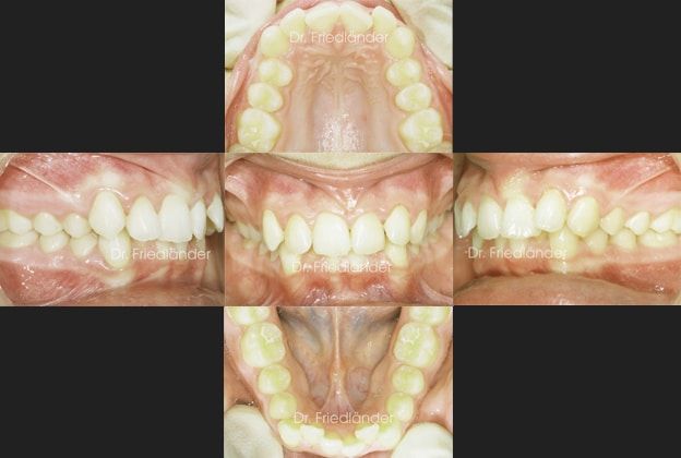 Ortodoncia Friedlander Barcelona iv inicial ortodoncia friedlander barcelona invisalign invisible lingual incognito damon