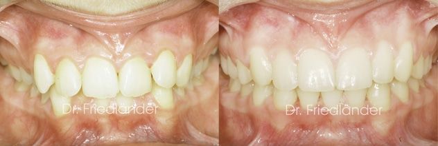 Ortodoncia Friedlander Barcelona perio ortodoncia friedlander barcelona invisalign invisible lingual incognito damon