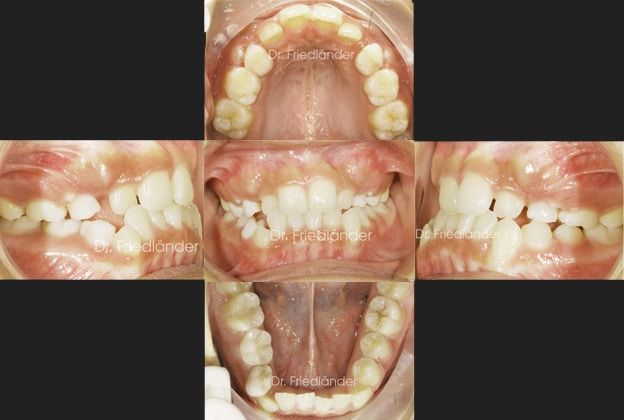 Ortodoncia Friedlander Barcelona final tratamiento extracción de incisivo inferior