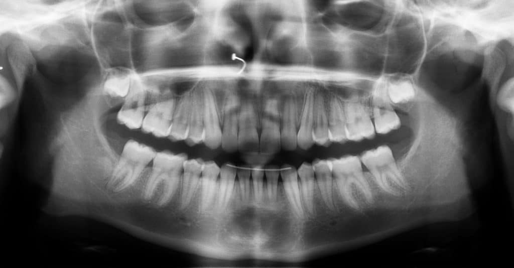 opg ortodoncia friedlander barcelona ortodoncia friedlander barcelona invisalign invisible lingual incognito damon