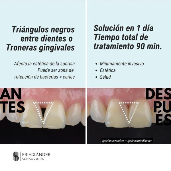 friedlander-troneras gingivales Troneras gingivales y tratamiento