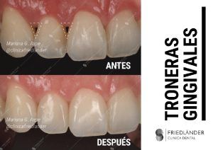 Troneras gingivales