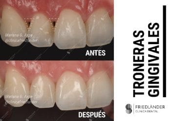 Troneras gingivales