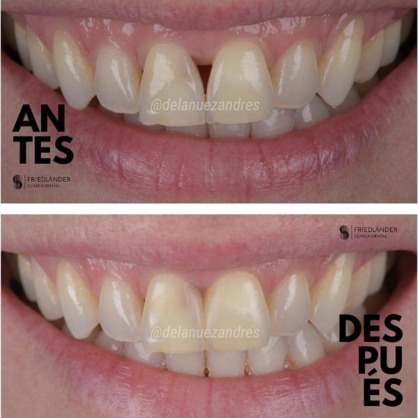 troneras gingivales antes depues troneras gingivales antes depues