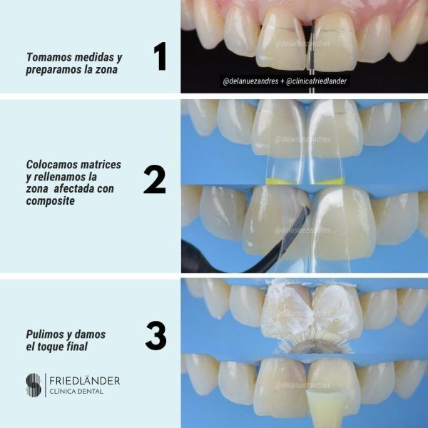 trtamiento troneras gingivales trtamiento troneras gingivales