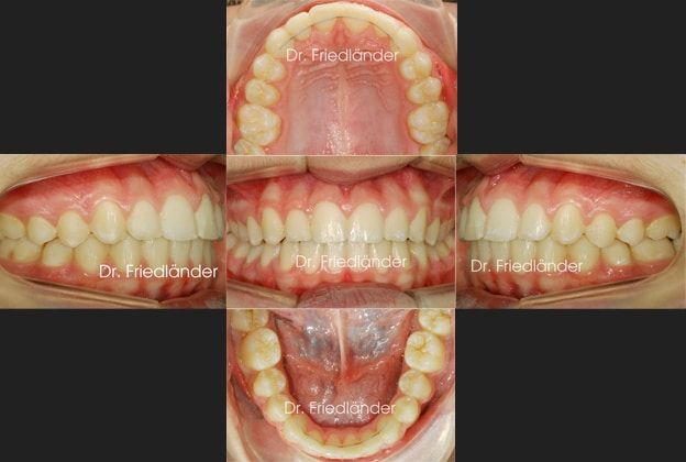 Ortodoncia Friedlander Barcelona Final ortodoncia friedlander barcelona estetica invisalign incognito lingual invisible adultos