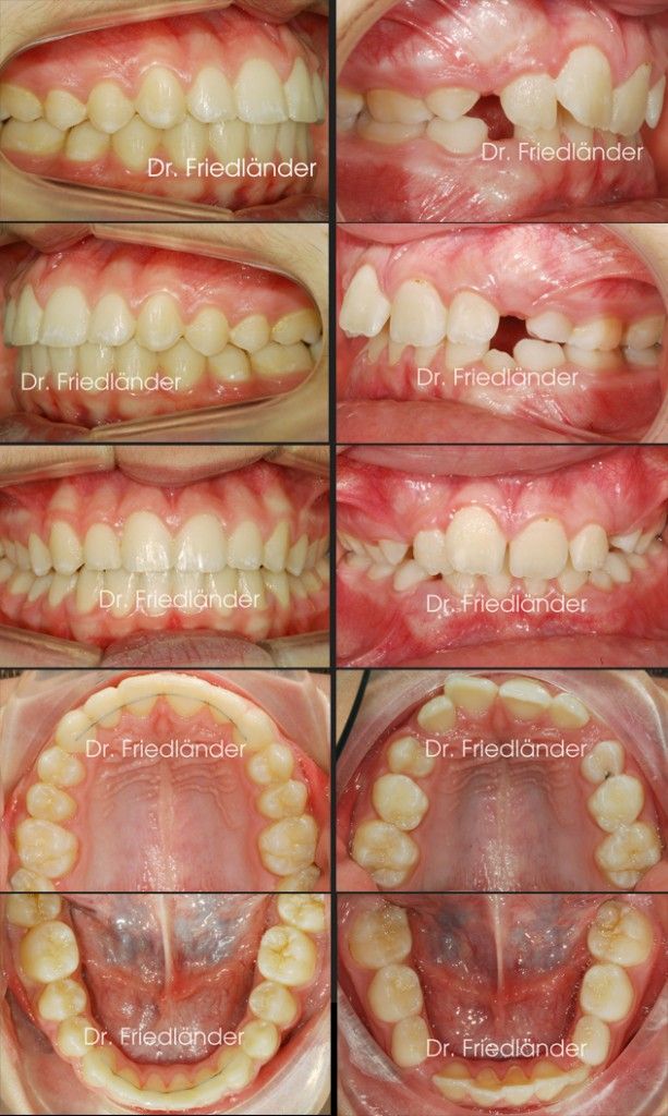 Ortodoncia Friedlander Barcelona comparacion antes despues ortodoncia friedlander barcelona estetica invisalign incognito lingual invisible adultos