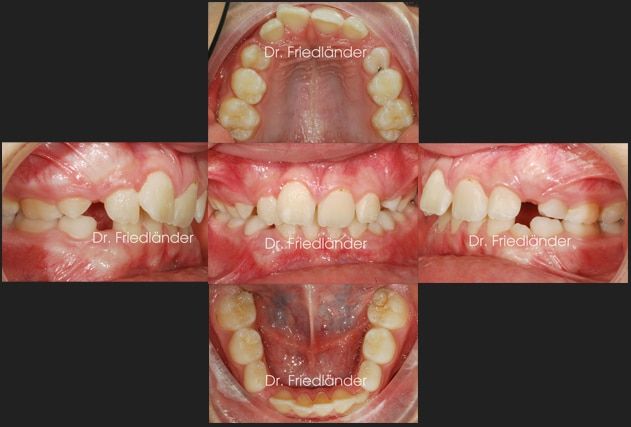 Ortodoncia Friedlander Barcelona inicial ortodoncia friedlander barcelona estetica invisalign incognito lingual invisible adultos