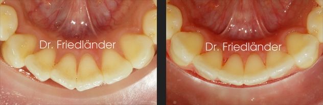 Friedlander Ortodoncia Barcelona - Lingual invisible social six final Friedlander Ortodoncia Barcelona Lingual invisible invisalign incognito estetica adultos