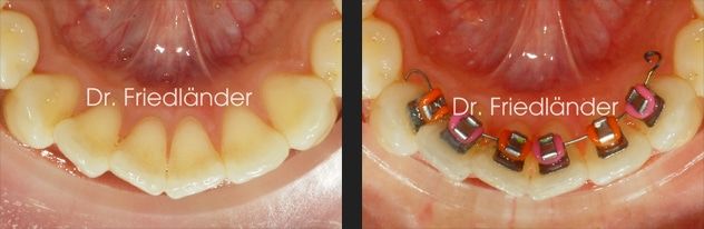 Friedlander Ortodoncia Barcelona - Lingual invisible social six i Friedlander Ortodoncia Barcelona Lingual invisible invisalign incognito estetica adultos