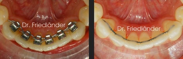 Friedlander Ortodoncia Barcelona - Lingual invisible social six inter Friedlander Ortodoncia Barcelona Lingual invisible invisalign incognito estetica adultos