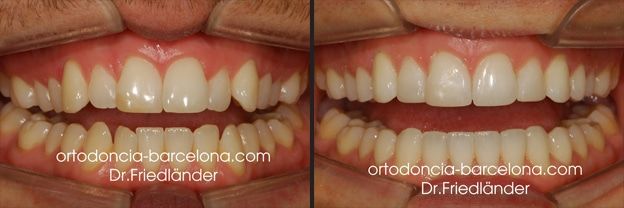 Friedlander Ortodoncia Barcelona Invisalign Invisible Lingual Incognito Transparente Adultos (1) Friedlander Ortodoncia Barcelona Invisalign Invisible Lingual Incognito Transparente