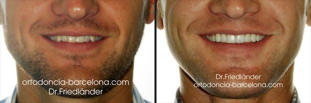 Friedlander Ortodoncia Barcelona Invisalign Invisible Lingual Incognito Transparente Adultos (2) Casos reales y experiencias en Friedländer