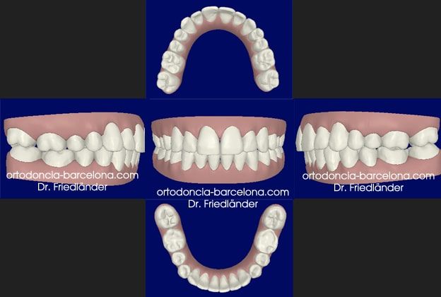 Friedlander Ortodoncia Barcelona Invisalign Invisible Lingual Incognito Transparente Adultos (3) Friedlander Ortodoncia Barcelona Invisalign Invisible Lingual Incognito Transparente