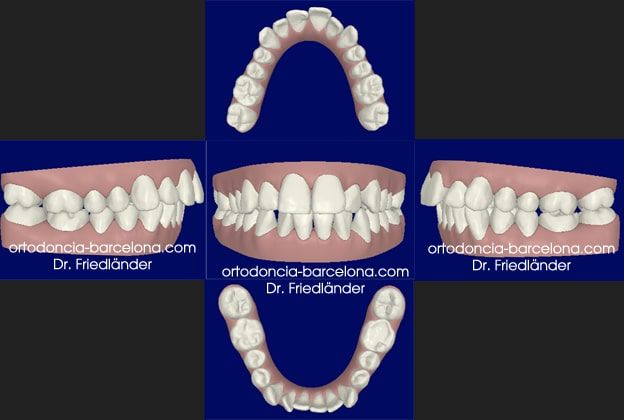 Friedlander Ortodoncia Barcelona Invisalign Invisible Lingual Incognito Transparente Adultos (4) Friedlander Ortodoncia Barcelona Invisalign Invisible Lingual Incognito Transparente