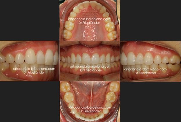 Friedlander Ortodoncia Barcelona Invisalign Invisible Lingual Incognito Transparente Adultos (5) Friedlander Ortodoncia Barcelona Invisalign Invisible Lingual Incognito Transparente