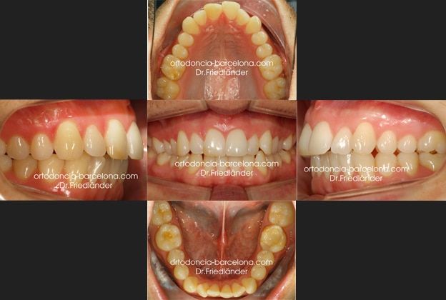 Friedlander Ortodoncia Barcelona Invisalign Invisible Lingual Incognito Transparente Adultos (6) Friedlander Ortodoncia Barcelona: Tratamiento con Invisalign
