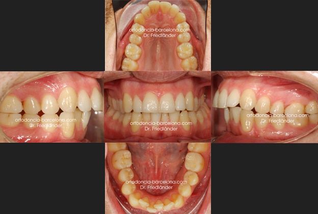 Ortodoncia Friedlander Barcelona Invisalign lingual invisible transparente incognito estetica (1) cirugía ortognática que es