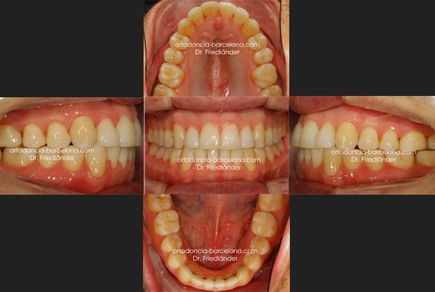 Ortodoncia Friedlander Barcelona Invisalign lingual invisible transparente incognito estetica (2) resultado final a nivel dental cirugía ortognática