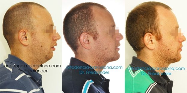 Ortodoncia Friedlander Barcelona Invisalign lingual invisible transparente incognito estetica (3) Cirugía ortognática bimaxilar tras tratamiento de 15 meses