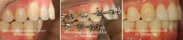 Ortodoncia Friedlander Barcelona Invisalign lingual invisible transparente incognito estetica (5) antes y después Cirugía ortognática bimaxilar