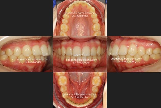 Ortodoncia Friedlander Barcelona Invisalign Lingual invisible transparente incognito win (2)
