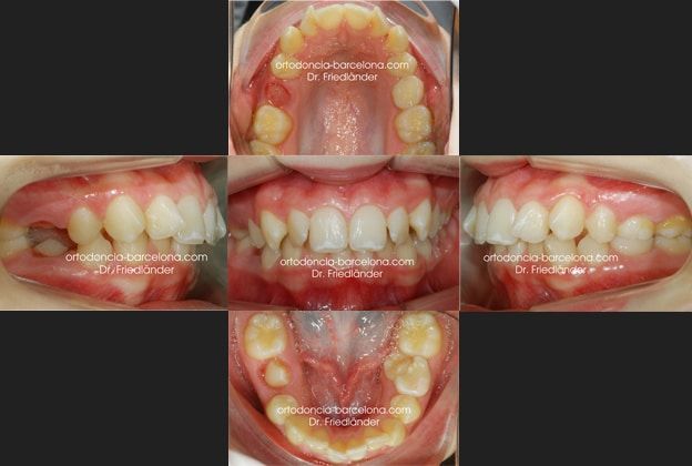 Ortodoncia Friedlander Barcelona Invisalign Lingual invisible transparente incognito win (2)