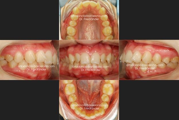 Ortodoncia Friedlander Barcelona Invisalign Lingual invisible transparente incognito win (2)
