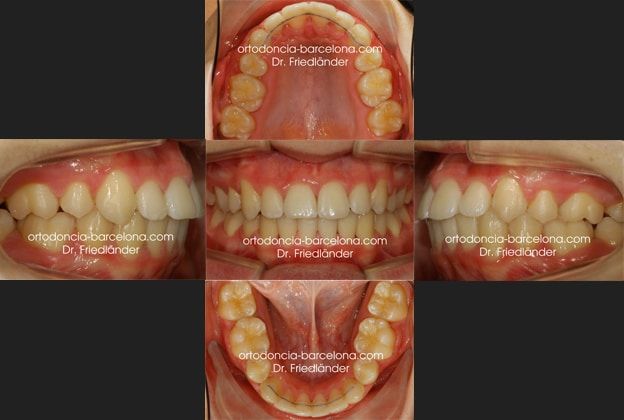 1 Ortodoncia Friedländer Barcelona invisalign lingual invisible transparente ortodoncista m Ortodoncia Friedländer Barcelona invisalign lingual invisible transparente ortodoncista