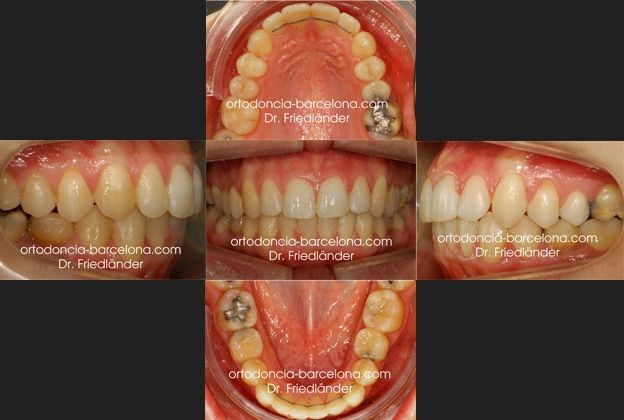 Ortodoncia Friedlander Barcelona Invisible invisalign lingual incognito transparente (1) Ortodoncia Friedlander Barcelona Invisible invisalign lingual incognito transparente (1)