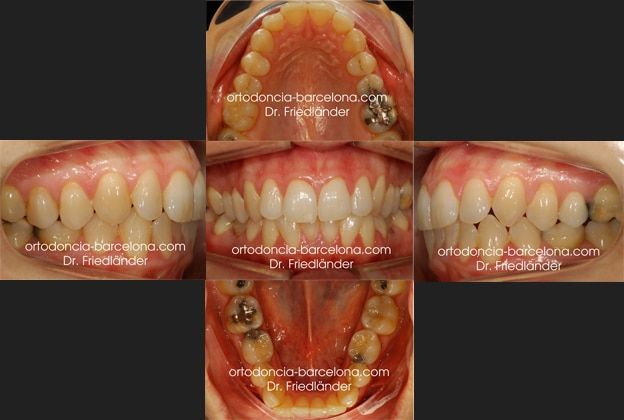 Ortodoncia Friedlander Barcelona Invisible invisalign lingual incognito transparente (2) agenesia dental tratamiento, fase inicial