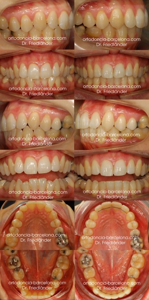 Ortodoncia Friedlander Barcelona Invisible invisalign lingual incognito transparente (3) Ortodoncia Friedlander Barcelona Invisible invisalign lingual incognito transparente