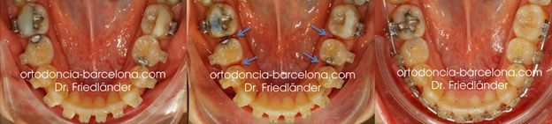 Ortodoncia Friedlander Barcelona Invisible invisalign lingual incognito transparente (4) agenesia dental, reducción interproximal
