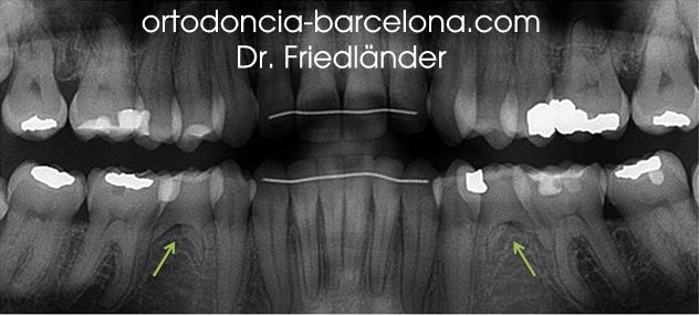 Ortodoncia Friedlander Barcelona Invisible invisalign lingual incognito transparente orto (2) Ortodoncia Friedlander Barcelona Invisible invisalign lingual incognito transparente (2)