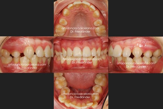 Ortodoncia Friedländer Barcelona invisalign lingual invisible transparente ortodoncista (3) Ortodoncia Friedländer Barcelona invisalign lingual invisible transparente ortodoncista (3)