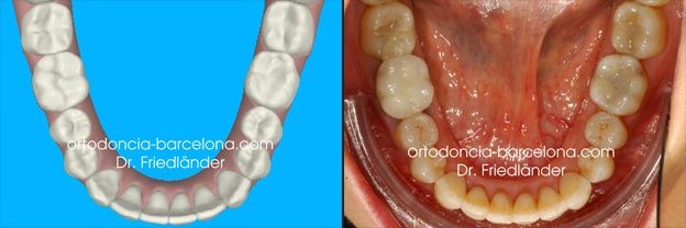 Ortodoncia Friedlander Barcelona clincheck Invisalign invisble lingual incognito transparente (1) Ortodoncia Friedlander Barcelona clincheck Invisalign invisble lingual incognito transparente (1)