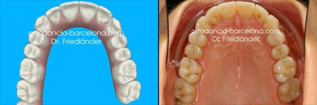 Ortodoncia Friedlander Barcelona clincheck Invisalign invisble lingual incognito transparente (2) Ortodoncia Friedlander Barcelona clincheck Invisalign invisble lingual incognito transparente (1)