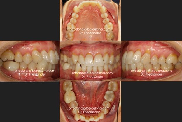Ortodoncia Friedländer Barcelona Invisalign lingual invisible transparente estetica gracia (1) Ortodoncia Friedländer Barcelona Invisalign lingual invisible transparente estetica gracia (4)