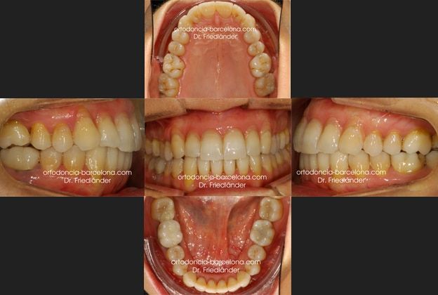 Ortodoncia Friedländer Barcelona Invisalign lingual invisible transparente estetica gracia (2) Ortodoncia Friedländer Barcelona Invisalign lingual invisible transparente estetica gracia (4)