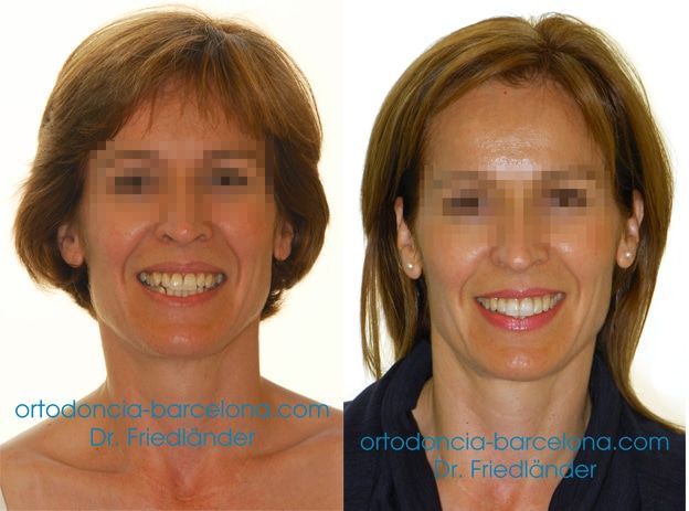 Ortodoncia Friedländer Barcelona Invisalign lingual invisible transparente estetica gracia (3) Ortodoncia Friedländer Barcelona Invisalign lingual invisible transparente estetica gracia (4)