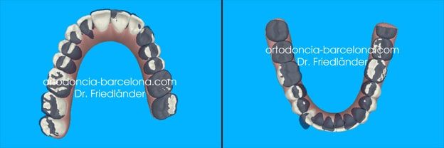 Ortodoncia Friedländer Barcelona Invisalign lingual invisible transparente estetica gracia (4) Ortodoncia Friedländer Barcelona Invisalign lingual invisible transparente estetica gracia (4)