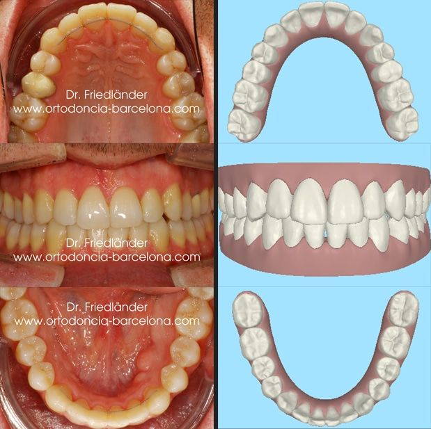 Ortodoncia Barcelona Friedlander Invisalign lingual invisible transparente estetica incognito ( Ortodoncia Barcelona Friedlander Invisalign lingual invisible transparente estetica incognito (