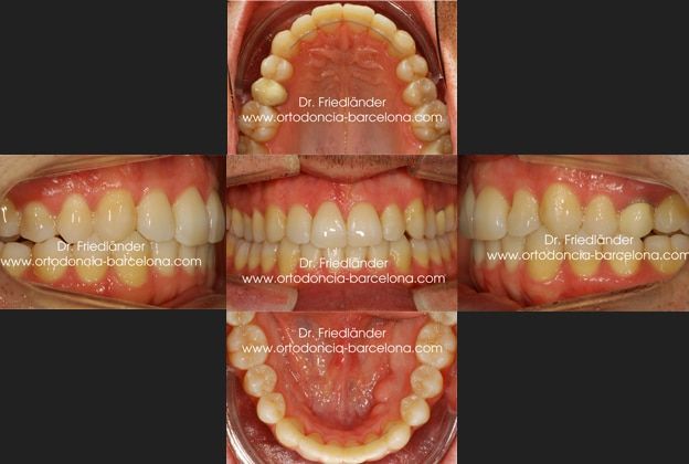 Ortodoncia Barcelona Friedlander Invisalign lingual invisible transparente estetica incognito (1) Ortodoncia Barcelona Friedlander Invisalign lingual invisible transparente estetica incognito (4)