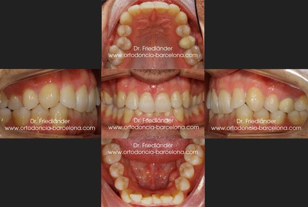 Ortodoncia Barcelona Friedlander Invisalign lingual invisible transparente estetica incognito (3) Ortodoncia Barcelona Friedlander Invisalign lingual invisible transparente estetica incognito (4)